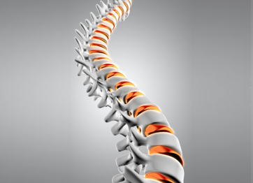 Mengenal Skoliosis, Gejala & Cara penanganannya